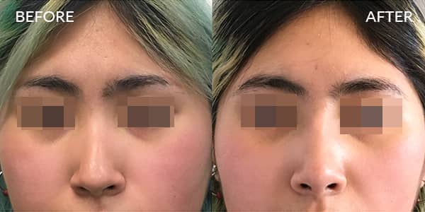 Asian Rhinoplasty