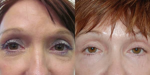 Blepharoplasty London 111 Harley St.