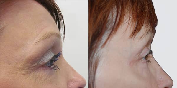 Blepharoplasty London 111 Harley St.