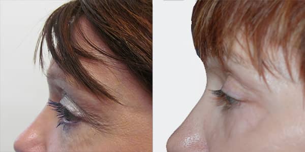 Blepharoplasty London 111 Harley St.