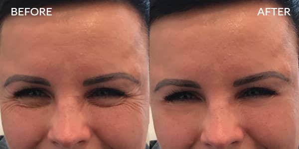 Botox for Frown and Crow feet