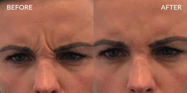 Botox for Frown and Crow feet