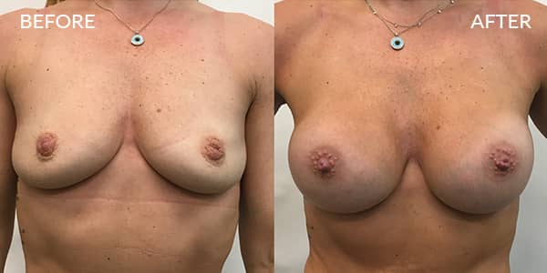 Breast-Augmentation-London-1