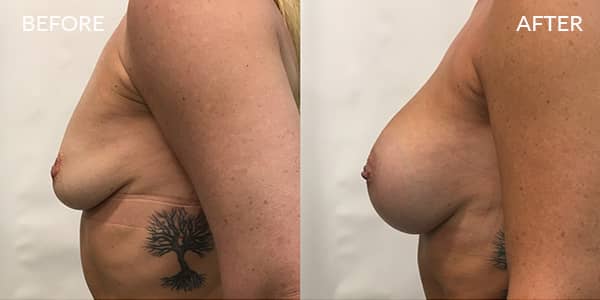 Breast-Augmentation-London-1