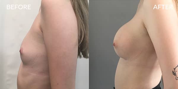 Breast-Augmentation-London-1