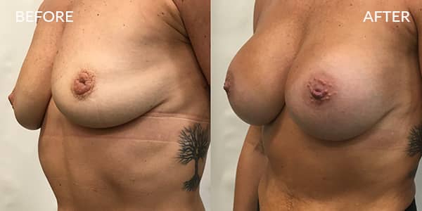 Breast-Augmentation-London-1