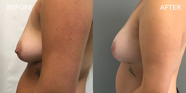 Breast-Lift-and-Areola-reduction