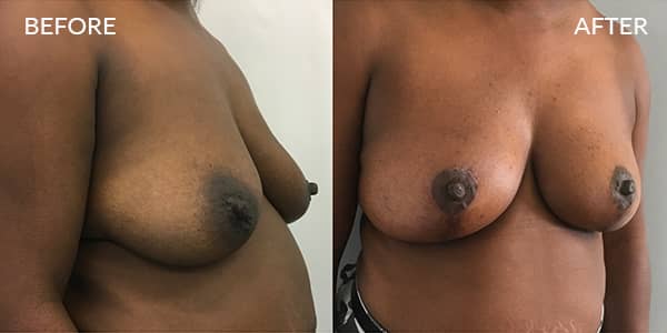 Breast Uplift London