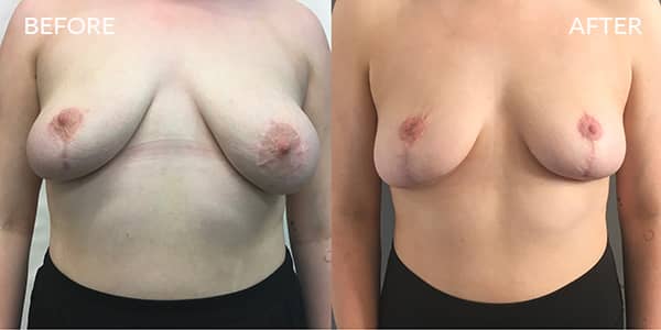 Breast Uplift London