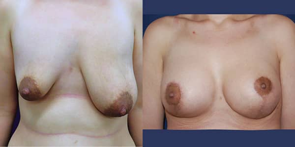 Breast Uplift 111 Harley St.