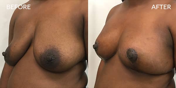 Breast Uplift London