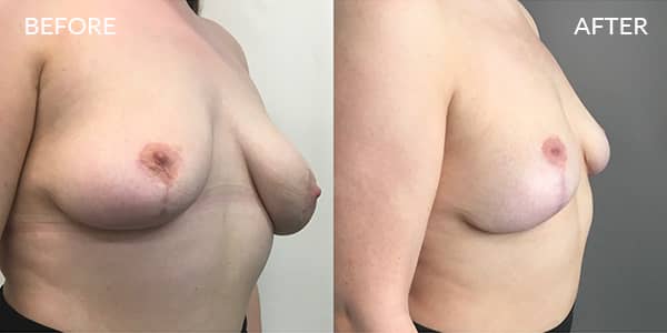 Breast Uplift London