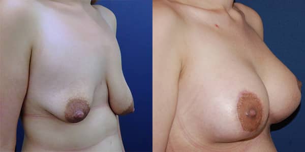 Breast Uplift 111 Harley St.