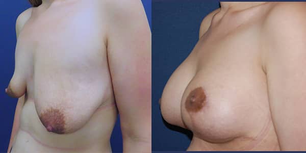 Breast Uplift 111 Harley St.