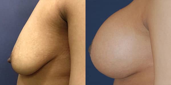 Breast Uplift 111 Harley St.