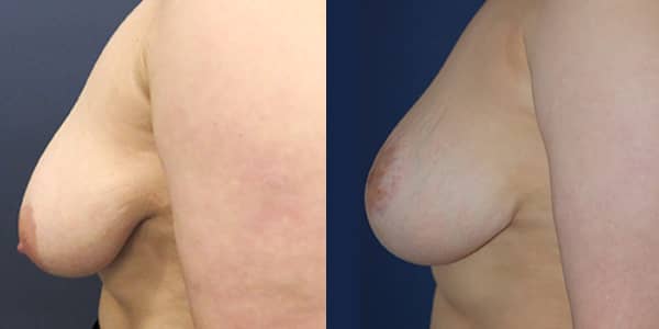 Breast Uplift 111 Harley St.