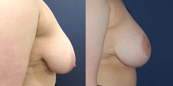 Breast Uplift 111 Harley St.