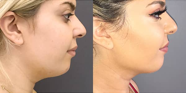 Buccal Fat Removal and Submental Liposuction