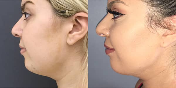 Buccal Fat Removal and Submental Liposuction