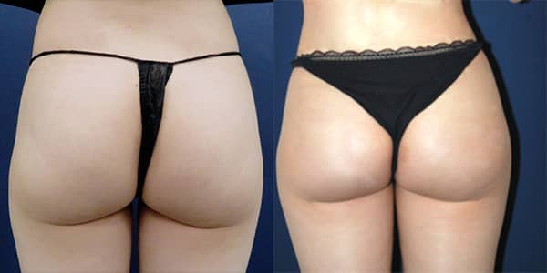 London Buttock Implant 111 Harley St