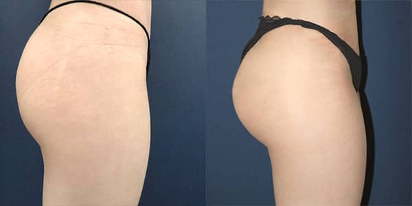 London Buttock Implant 111 Harley St
