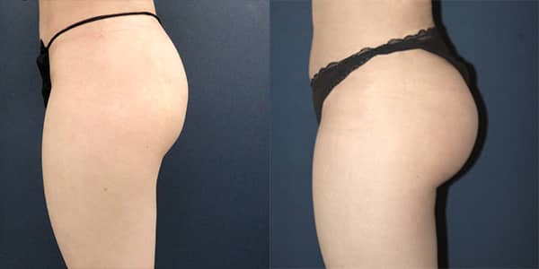 London Buttock Implant 111 Harley St