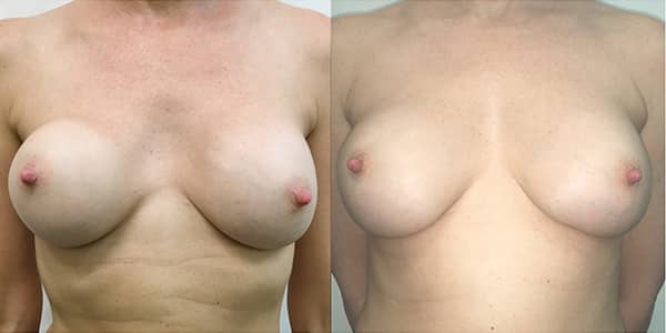 Change of Breast Implant