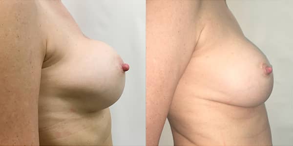 Change of Breast Implant