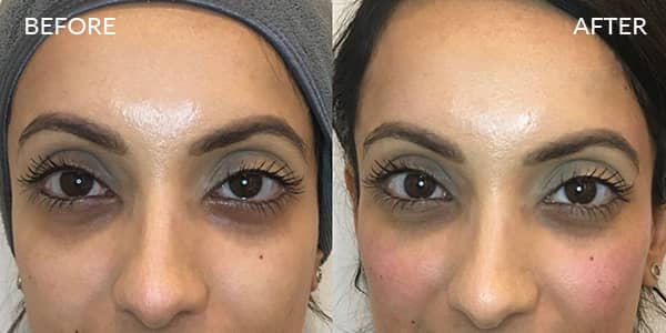 Dermal Filler Cheek and Temple London