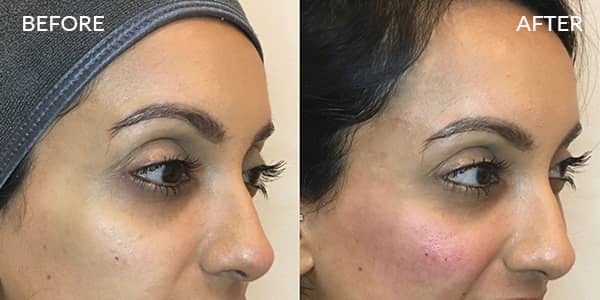 Dermal Filler Cheek and Temple London