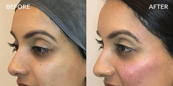 Dermal Filler Cheek and Temple London