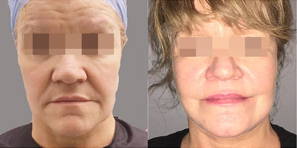 Facelift & Neck Lift London 111 Harley St.