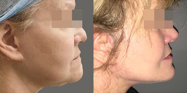 Facelift & Neck Lift London 111 Harley St.