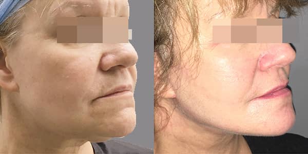 Facelift & Neck Lift London 111 Harley St.