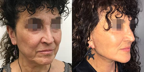 Facelift & Neck Lift London 111 Harley St.