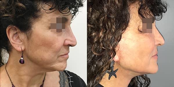 Facelift & Neck Lift London 111 Harley St.