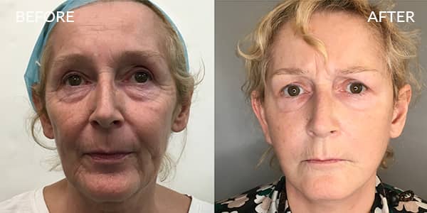Facelift-and-Necklift-London