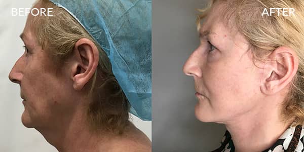 Facelift-and-Necklift-London