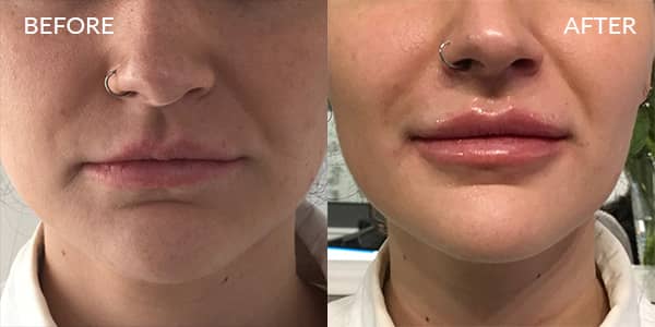 Lip-Filler-London