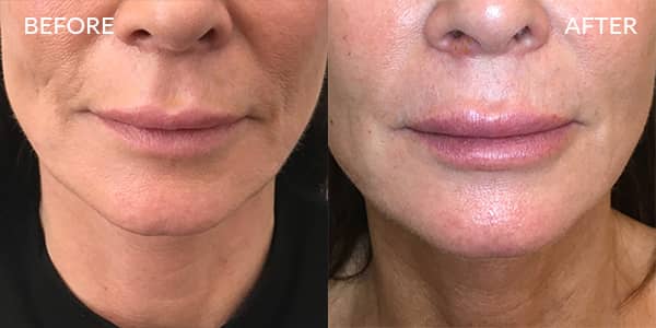 Lip-Filler-London