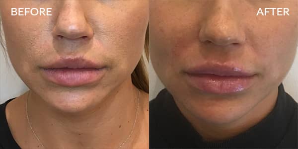 Lip-Filler-London