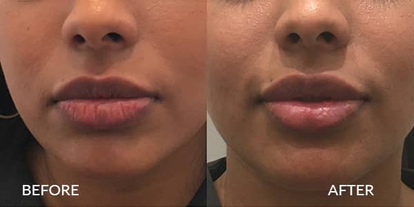 Lip Filler London