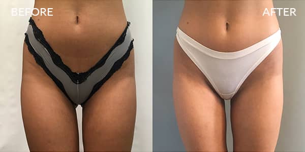 Liposuction-London