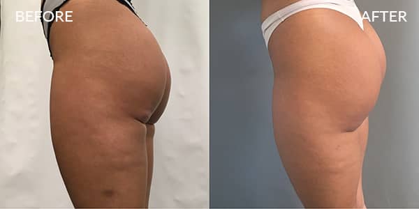 Liposuction-London