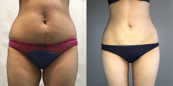 London Liposuction