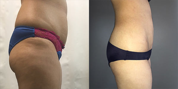 London Liposuction