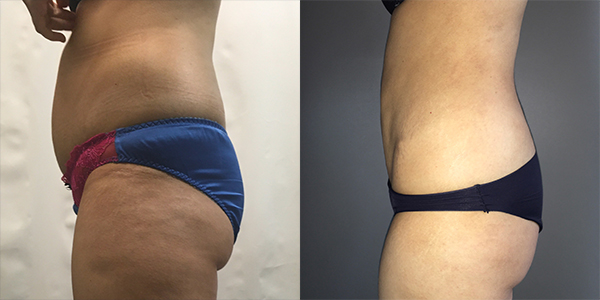 London Liposuction