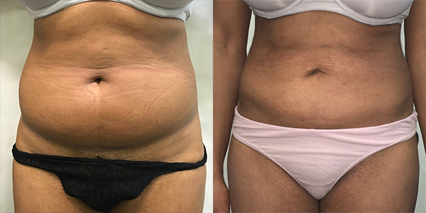 Liposuction Harley Street