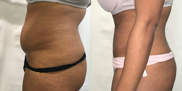 Liposuction Harley Street