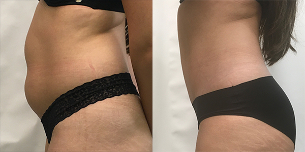 Liposuction Harley Street